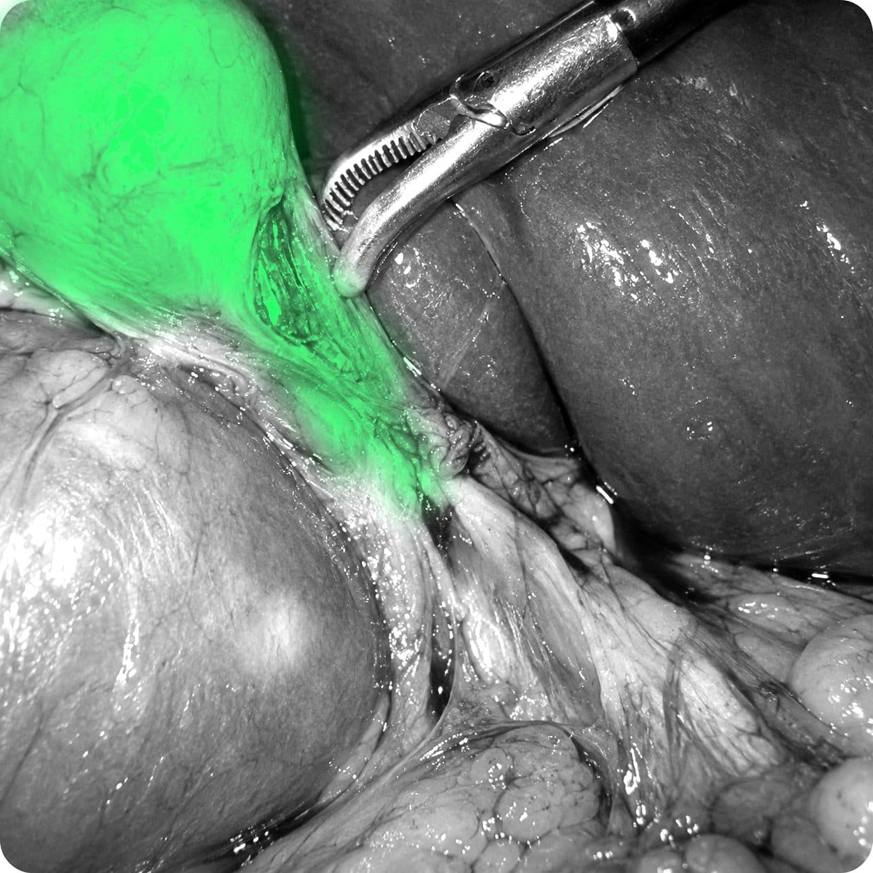 The same view in near-infrared monochrome with ICG fluorescence in green