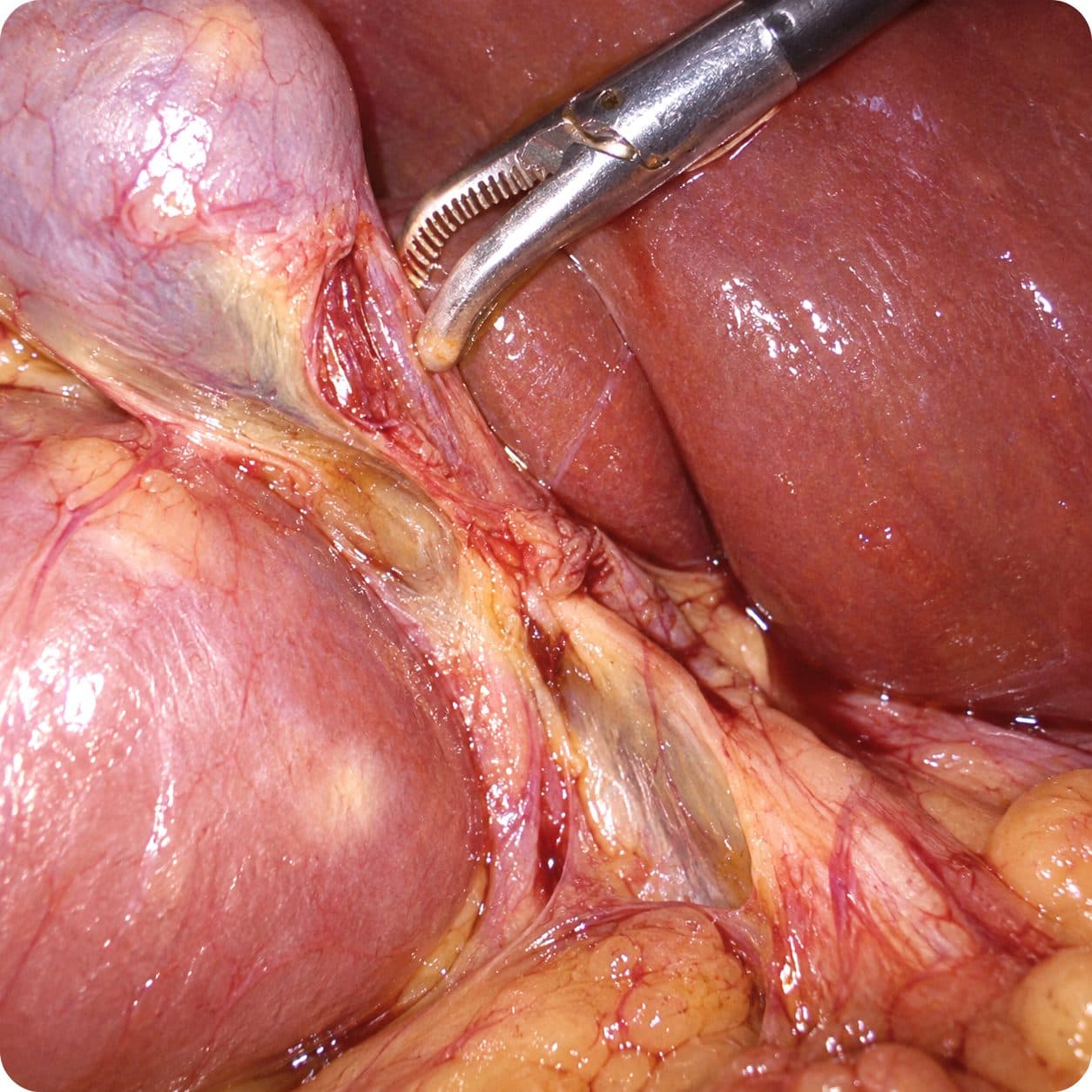 Laparoscopic view of the gallbladder and liver under white light
